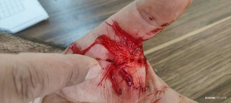 همکار واکسیناتور شبکه دامپزشکی شهرستان اردل مورد حمله سگ قرار گرفت و از ناحیه دست مجروح شد